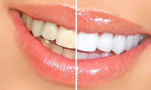 歯を内側から白くするホワイトニング