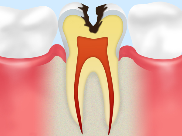 C2【象牙質のむし歯】