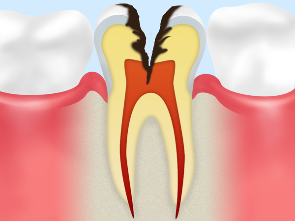 C3【神経まで達したむし歯】