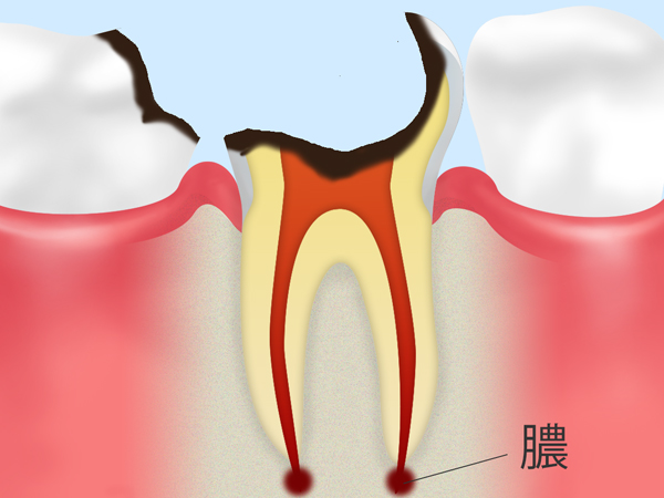 C4【歯根まで達したむし歯】